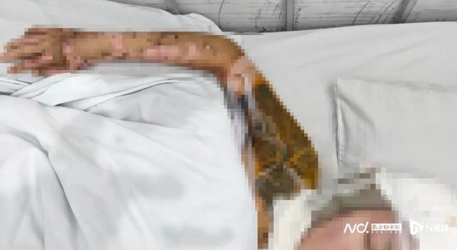 化学实验课因酒精外洒被点燃，致6名学生烧伤！伤情较重女生已植皮3次，多方回应