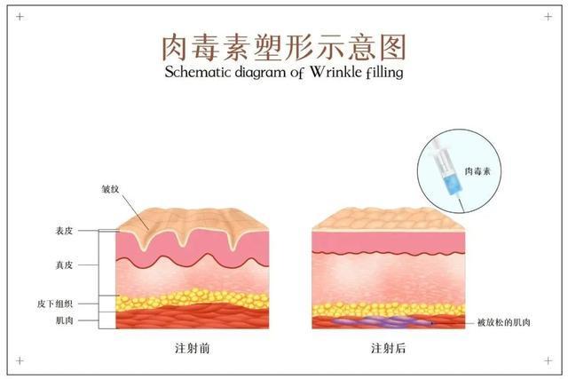 戚薇承认医美过度：整个眉毛完全动不了 医生提醒→